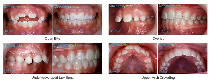 Healthy Start Orthodontics System